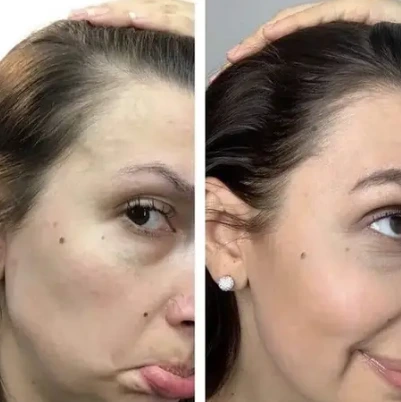 before and after Hair Perfecta